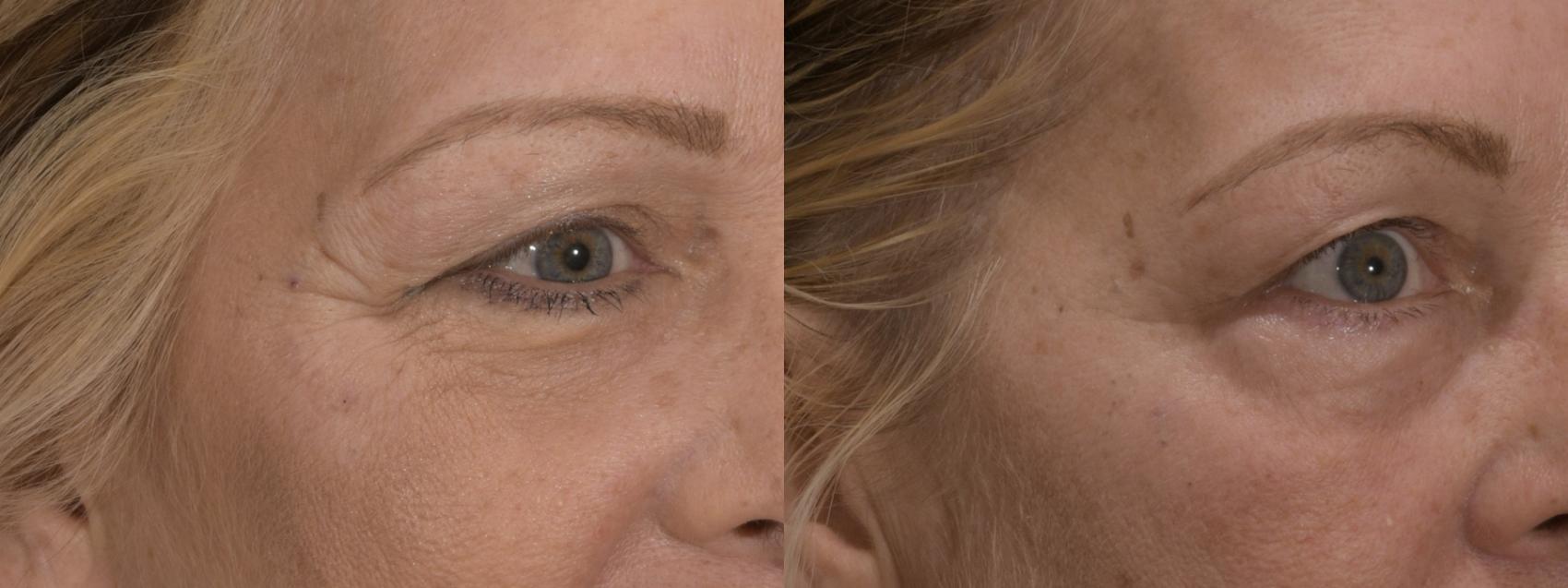 BOTOX Cosmetic Before And After Pictures Case 164 Rochester NY Q