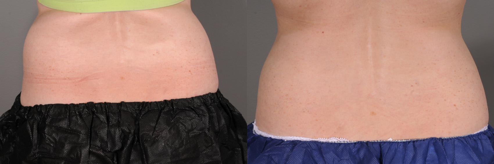 CoolSculpting® Case 108 Before & After View #1 | Rochester & Victor, NY | Q the Medical Spa