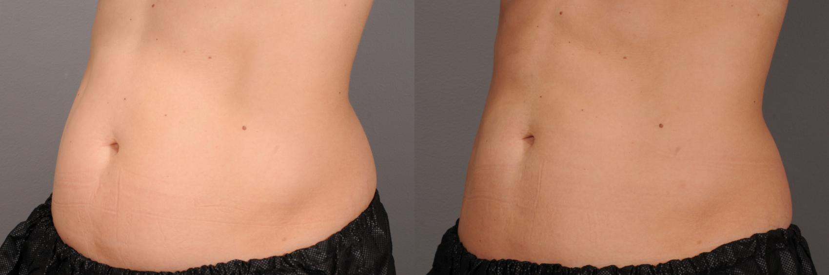 CoolSculpting® Case 136 Before & After View #1 | Rochester & Victor, NY | Q the Medical Spa
