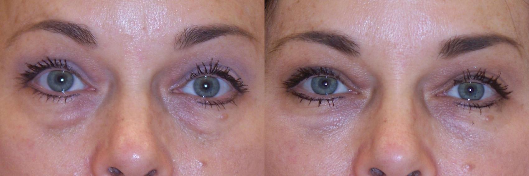 Dermal Fillers Case 65 Before & After View #1 | Rochester, NY | Q the Medical Spa