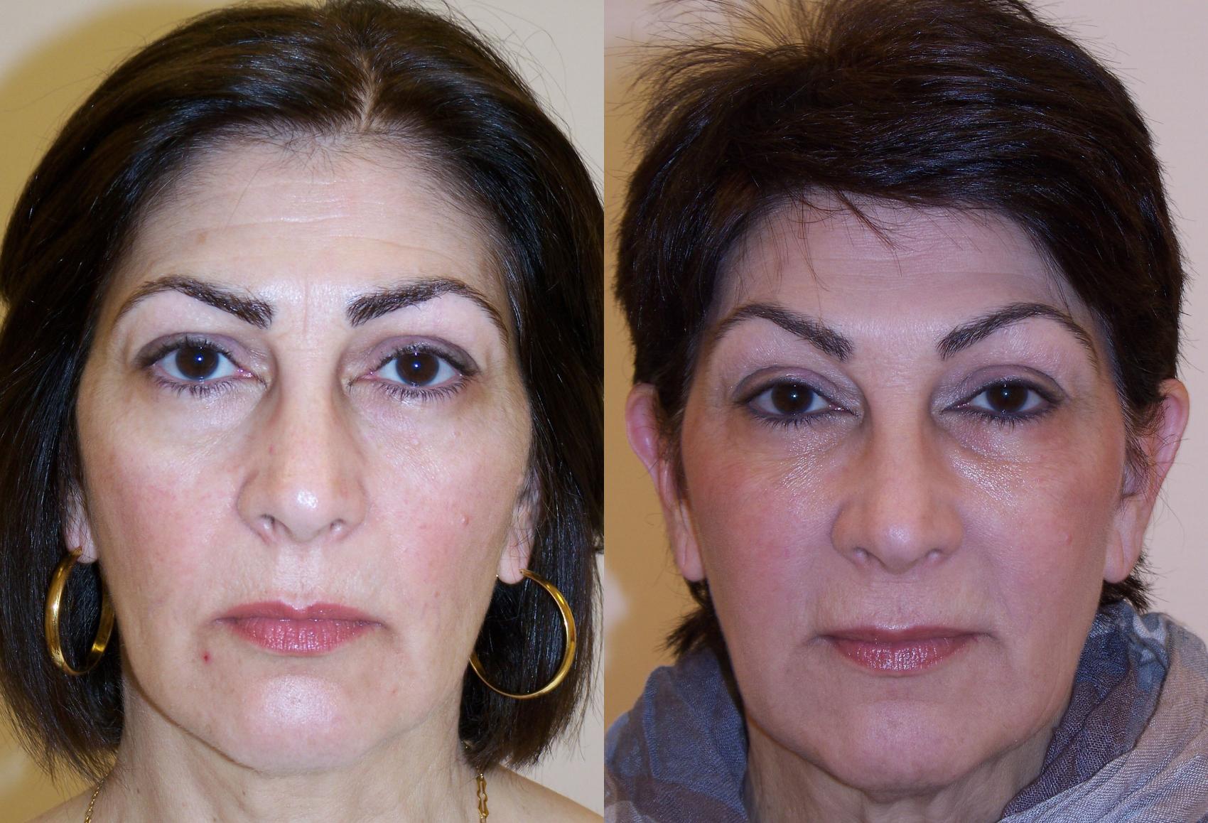 Dermal Fillers Case 66 Before & After View #1 | Rochester, NY | Q the Medical Spa