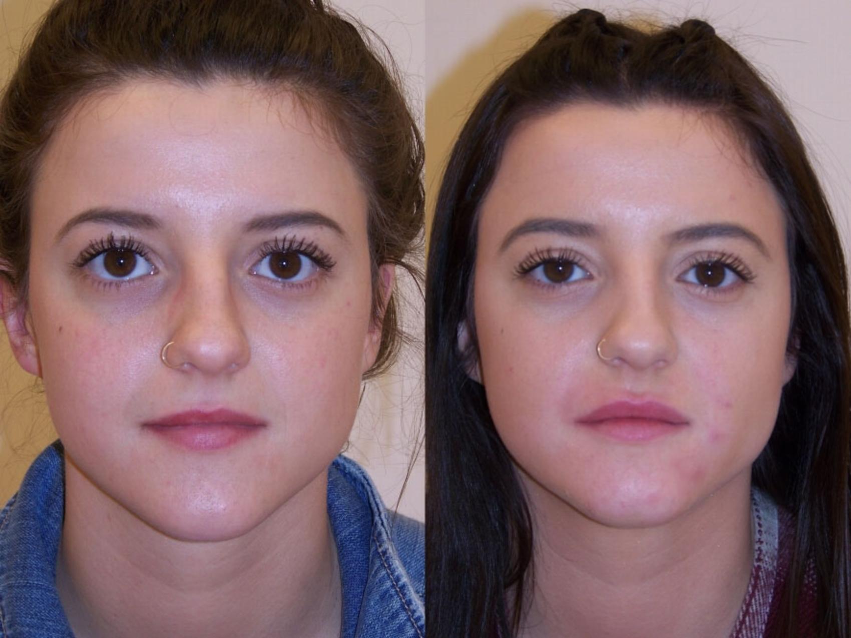 Dermal Fillers Case 83 Before & After View #1 | Rochester, NY | Q the Medical Spa