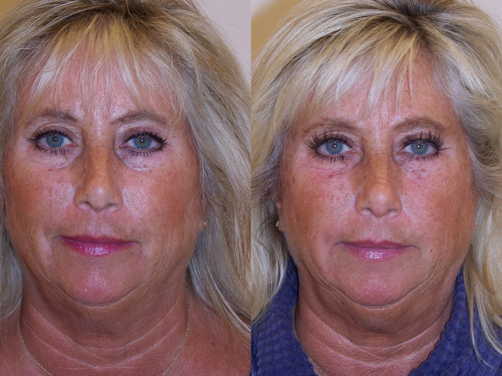 Dermal Fillers Case 92 Before & After View #1 | Rochester, NY | Q the Medical Spa