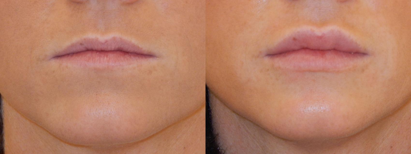 Dermal Fillers Case 94 Before & After View #1 | Rochester, NY | Q the Medical Spa