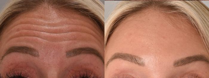Glabella Botox Case 158 Before & After Front | Rochester, NY | Q the Medical Spa