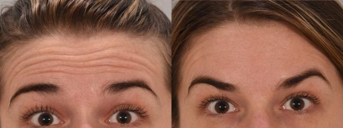 Glabella Botox Case 160 Before & After Front | Rochester, NY | Q the Medical Spa