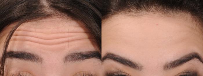 Glabella Botox Case 169 Before & After Front | Rochester, NY | Q the Medical Spa