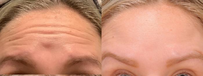 Glabella Botox Case 171 Before & After Front | Rochester, NY | Q the Medical Spa