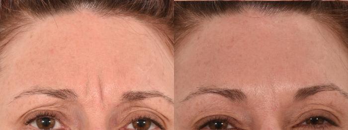 Glabella Botox Case 186 Before & After Front | Rochester, NY | Q the Medical Spa