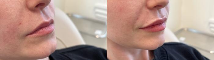Dermal Fillers Case 148 Before & After Right Oblique | Rochester, NY | Q the Medical Spa