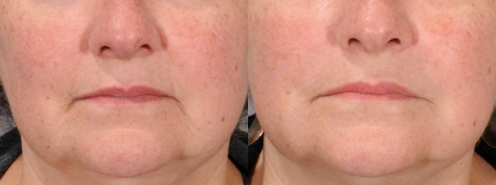 Nasolabial Folds Case 119 Before & After View #1 | Rochester, NY | Q the Medical Spa