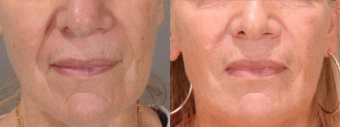 Nasolabial Folds Case 138 Before & After Front | Rochester, NY | Q the Medical Spa