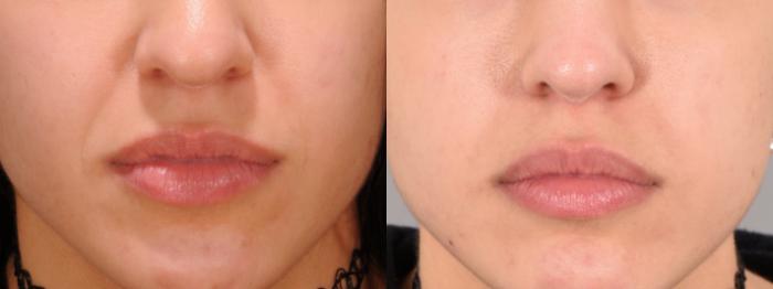 Nasolabial Folds Case 140 Before & After Front | Rochester, NY | Q the Medical Spa