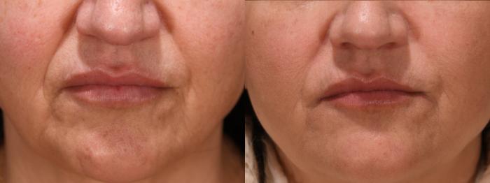 Nasolabial Folds Case 192 Before & After Front | Rochester, NY | Q the Medical Spa