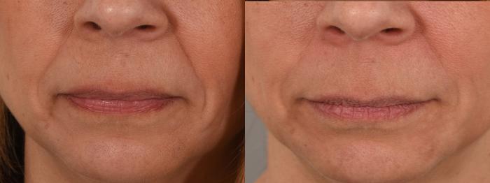 Nasolabial Folds Case 193 Before & After Front | Rochester, NY | Q the Medical Spa