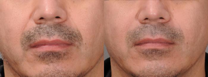 Nasolabial Folds Case 195 Before & After Front | Rochester, NY | Q the Medical Spa