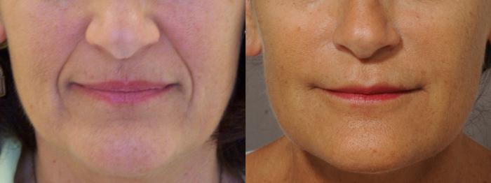 Nasolabial Folds Case 67 Before & After View #1 | Rochester, NY | Q the Medical Spa