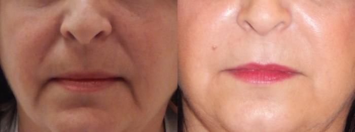 Nasolabial Folds Case 70 Before & After View #1 | Rochester, NY | Q the Medical Spa