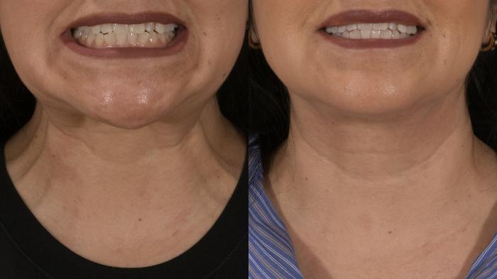 Platysma Bands Case 226 Before & After Front | Rochester, NY | Q the Medical Spa