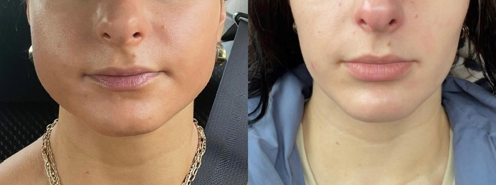 BOTOX® Cosmetic Case 155 Before & After Front | Rochester, NY | Q the Medical Spa