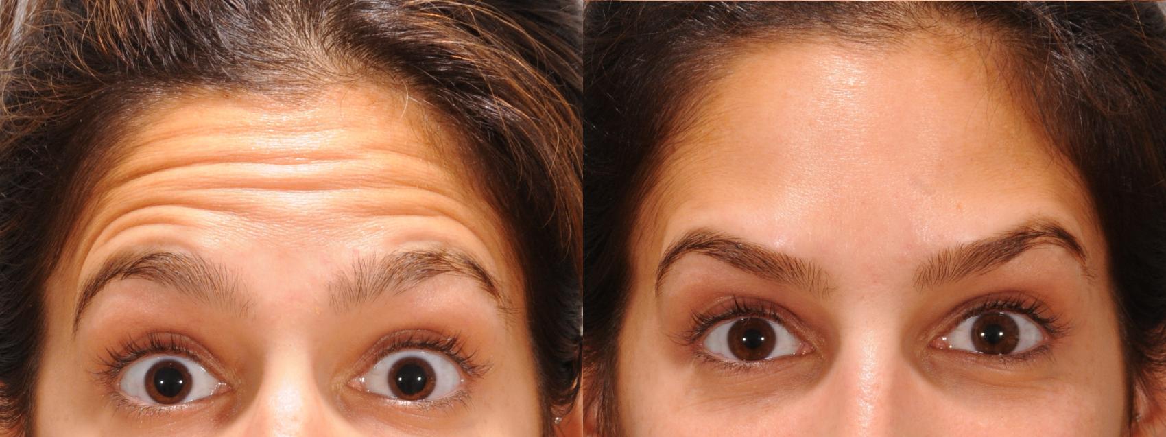 BOTOX® Cosmetic Case 156 Before & After Front | Rochester & Victor, NY | Q the Medical Spa