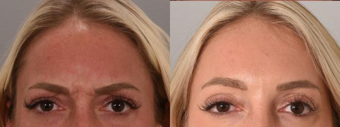 BOTOX® Cosmetic Case 158 Before & After Glabellar | Rochester & Victor, NY | Q the Medical Spa