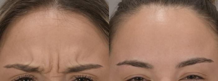 BOTOX® Cosmetic Case 159 Before & After Glabellar | Rochester & Victor, NY | Q the Medical Spa