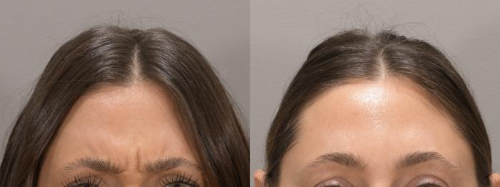 BOTOX® Cosmetic Case 161 Before & After Glabellar | Rochester & Victor, NY | Q the Medical Spa
