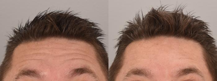 BOTOX® Cosmetic Case 163 Before & After Front | Rochester & Victor, NY | Q the Medical Spa