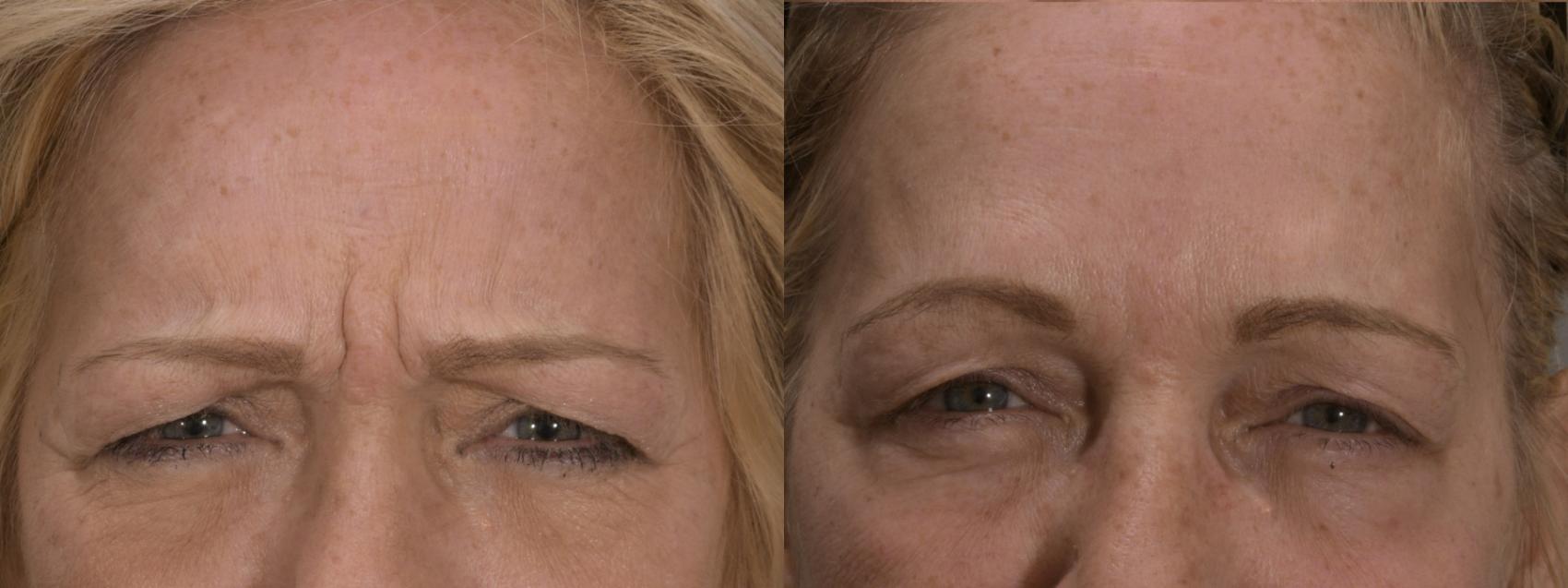 BOTOX® Cosmetic Case 164 Before & After Front | Rochester & Victor, NY | Q the Medical Spa