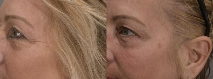 BOTOX® Cosmetic Case 164 Before & After Right Oblique | Rochester & Victor, NY | Q the Medical Spa