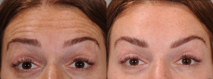 BOTOX® Cosmetic Case 167 Before & After Front | Rochester & Victor, NY | Q the Medical Spa
