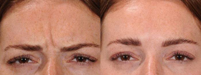 BOTOX® Cosmetic Case 167 Before & After Glabellar | Rochester & Victor, NY | Q the Medical Spa