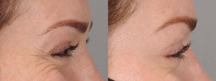 BOTOX® Cosmetic Case 167 Before & After Right Side | Rochester & Victor, NY | Q the Medical Spa