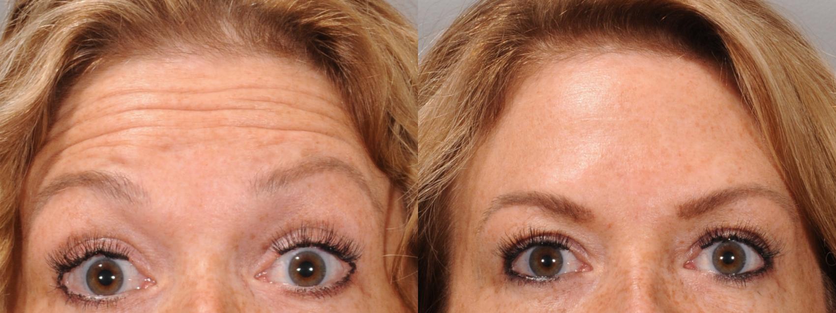 BOTOX® Cosmetic Case 168 Before & After Front | Rochester & Victor, NY | Q the Medical Spa