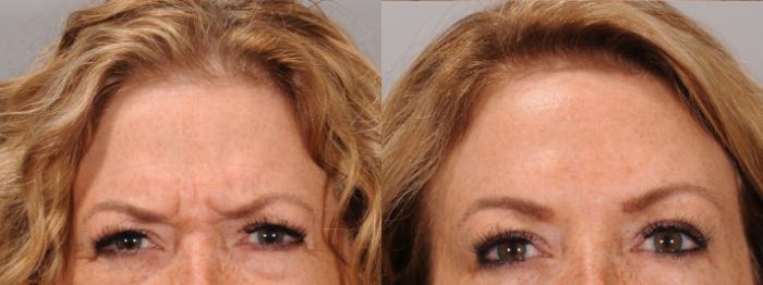 BOTOX® Cosmetic Case 168 Before & After Glabellar | Rochester & Victor, NY | Q the Medical Spa