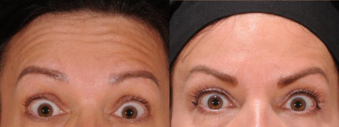 BOTOX® Cosmetic Case 172 Before & After Front | Rochester & Victor, NY | Q the Medical Spa