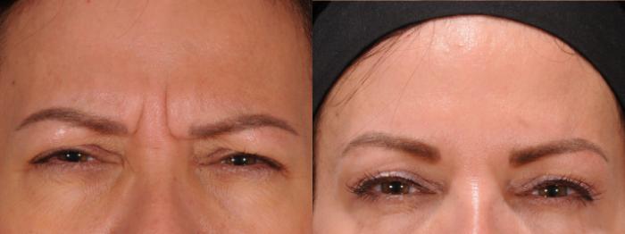 BOTOX® Cosmetic Case 172 Before & After Glabellar | Rochester & Victor, NY | Q the Medical Spa