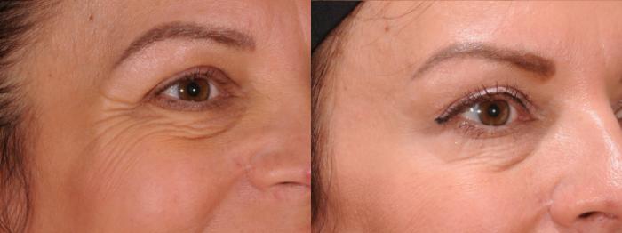 BOTOX® Cosmetic Case 172 Before & After Right Oblique | Rochester & Victor, NY | Q the Medical Spa