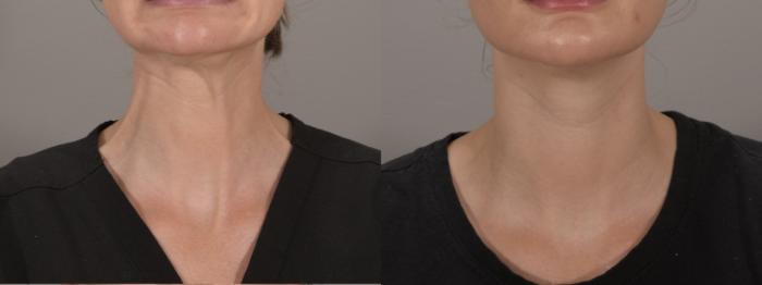 BOTOX® Cosmetic Case 175 Before & After Front | Rochester & Victor, NY | Q the Medical Spa