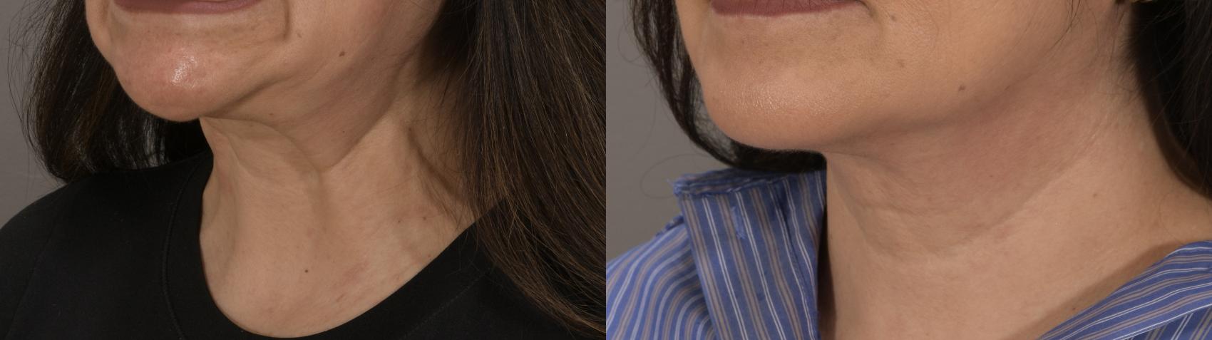 BOTOX® Cosmetic Case 226 Before & After Left Oblique | Rochester, NY | Q the Medical Spa