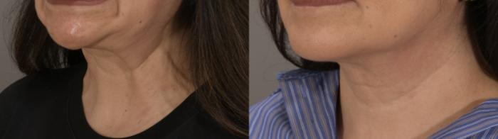 BOTOX® Cosmetic Case 226 Before & After Left Oblique | Rochester, NY | Q the Medical Spa