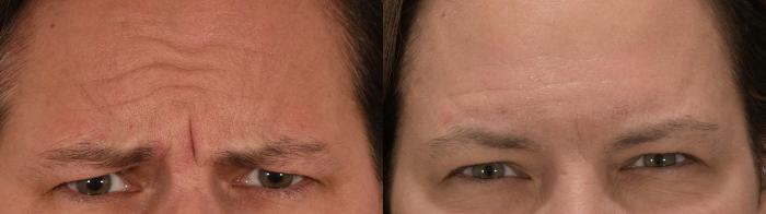 Glabella Botox Case 229 Before & After Front | Rochester, NY | Q the Medical Spa
