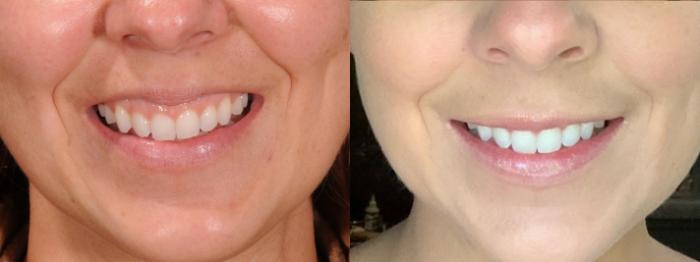 Lip Flip/Gummy Smile Case 230 Before & After Front | Rochester, NY | Q the Medical Spa