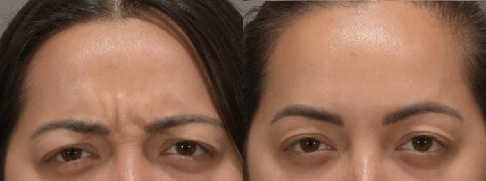 Glabella Botox Case 231 Before & After Front | Rochester, NY | Q the Medical Spa
