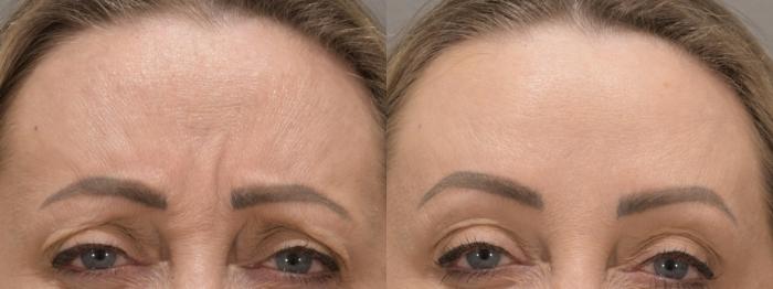Glabella Botox Case 233 Before & After Front | Rochester, NY | Q the Medical Spa