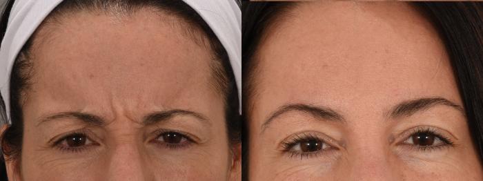 Glabella Botox Case 237 Before & After Front | Rochester, NY | Q the Medical Spa