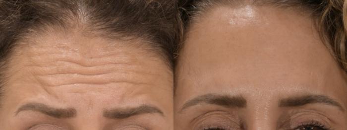 Forehead Botox Case 240 Before & After Front | Rochester, NY | Q the Medical Spa