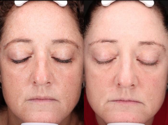 Chemical Peels Case 202 Before & After Front | Rochester & Victor, NY | Q the Medical Spa