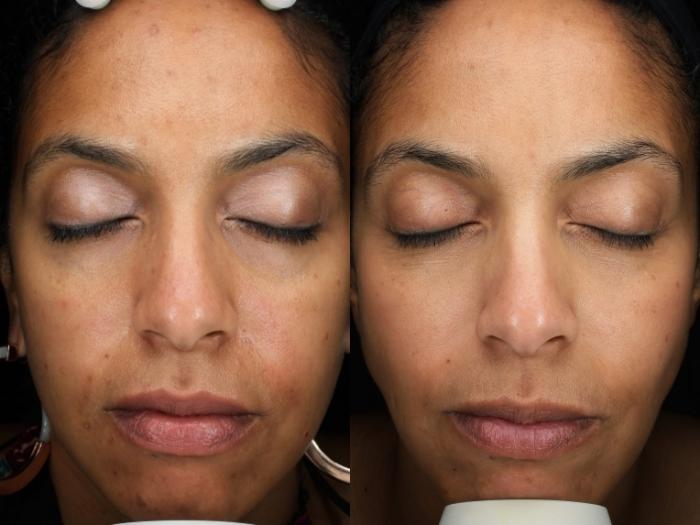 Chemical Peels Case 210 Before & After Front | Rochester & Victor, NY | Q the Medical Spa